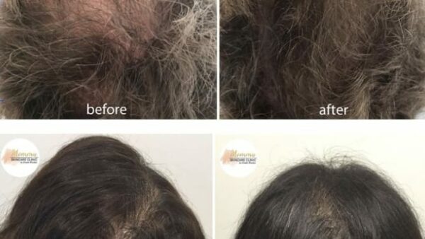 Mesotherapie